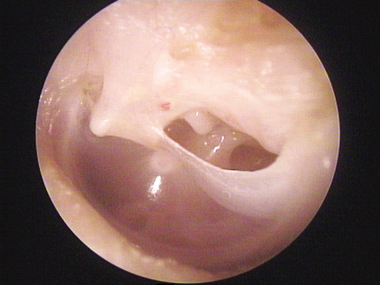 O perforacji błony bębenkowej - Zdrowie Polaków